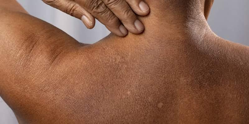 Skin Cancer in Dark Skin: Key Facts You Should Know